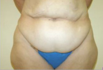 Body Lift Melbourne Before & After | Patient 01 Photo 0