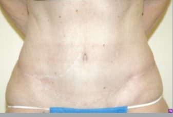 Body Lift Melbourne Before & After | Patient 01 Photo 1