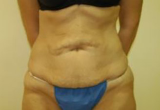 Body Lift Melbourne Before & After | Patient 02 Photo 0