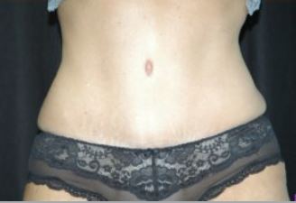 Body Lift Melbourne Before & After | Patient 02 Photo 1