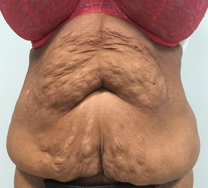 Body Lift Melbourne Before & After | Patient 03 Photo 0 Thumb