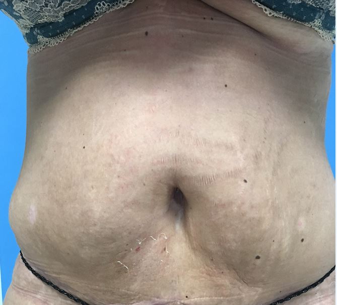 Body Lift Melbourne Before & After | Patient 03 Photo 1 Thumb