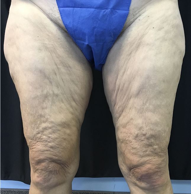 Thigh Lift Melbourne Before & After | Patient 01 Photo 0