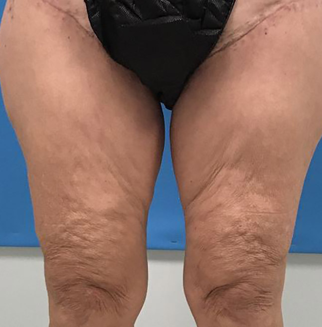 Thigh Lift Melbourne Before & After | Patient 01 Photo 1