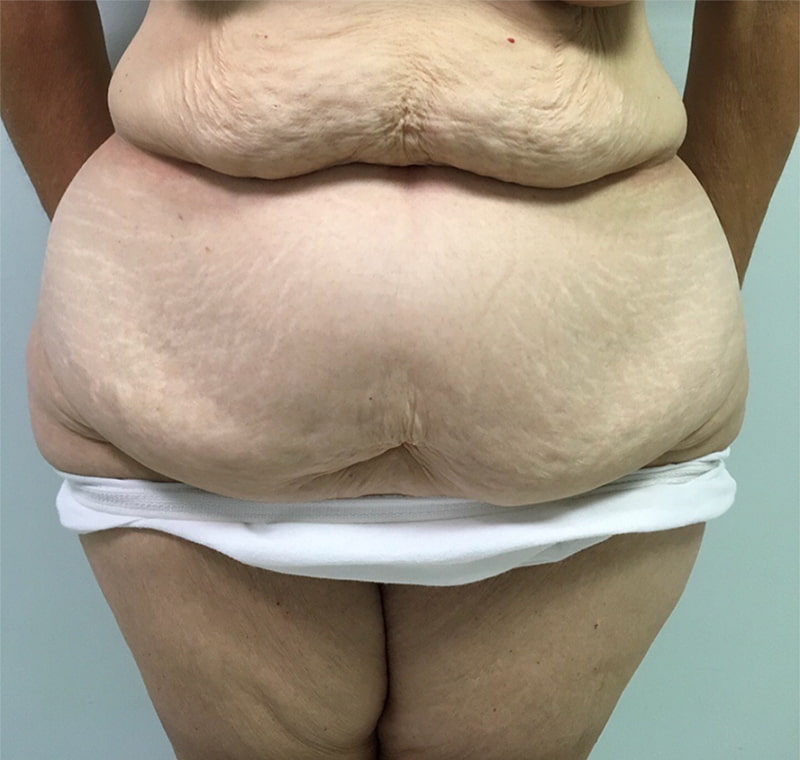 Tummy Tuck Melbourne Before & After | Patient 01 Photo 0 Thumb