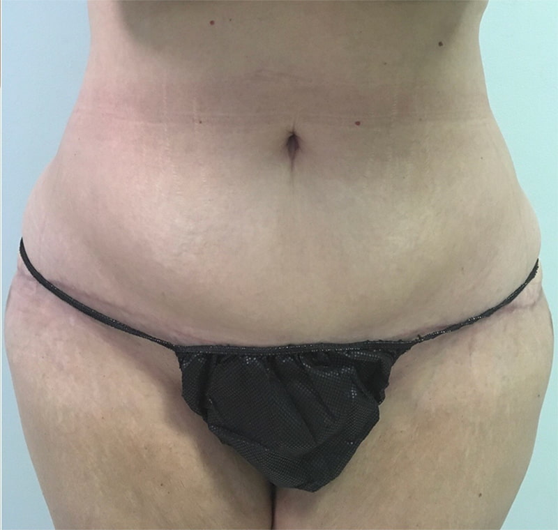 Tummy Tuck Melbourne Before & After | Patient 01 Photo 1