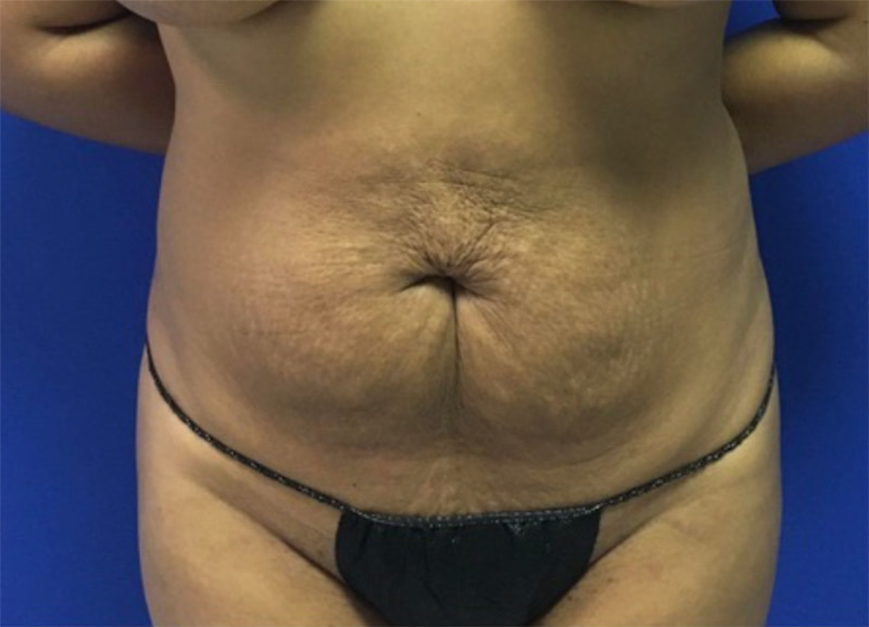 Tummy Tuck Melbourne Before & After | Patient 02 Photo 0