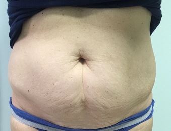 Tummy Tuck Melbourne Before & After | Patient 03 Photo 0 Thumb