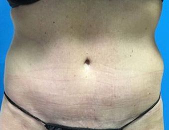 Tummy Tuck Melbourne Before & After | Patient 03 Photo 1