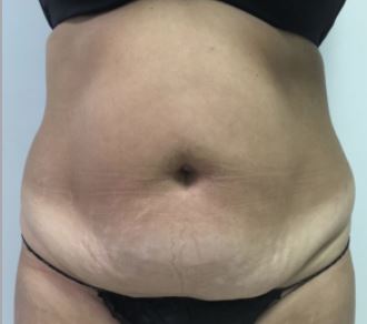 Tummy Tuck Melbourne Before & After | Patient 04 Photo 0