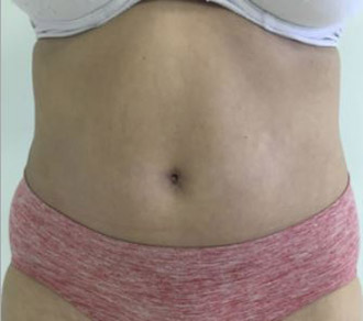 Tummy Tuck Melbourne Before & After | Patient 04 Photo 1