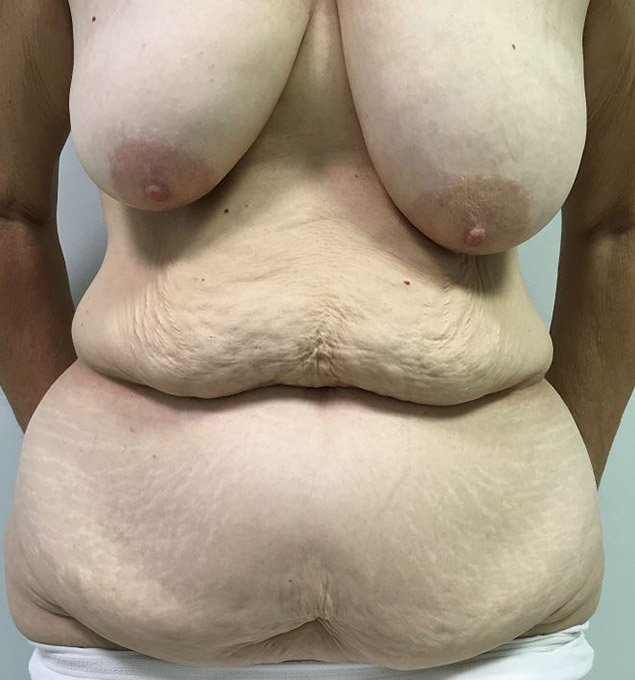 Tummy Tuck Melbourne Before & After | Patient 05 Photo 0 Thumb