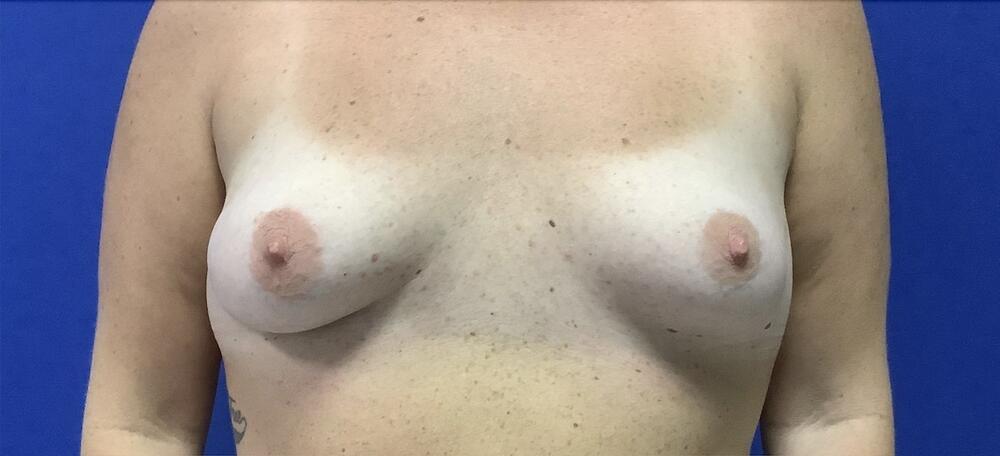 Breast Augmentation Melbourne Before & After | Patient 01 Photo 0 Thumb
