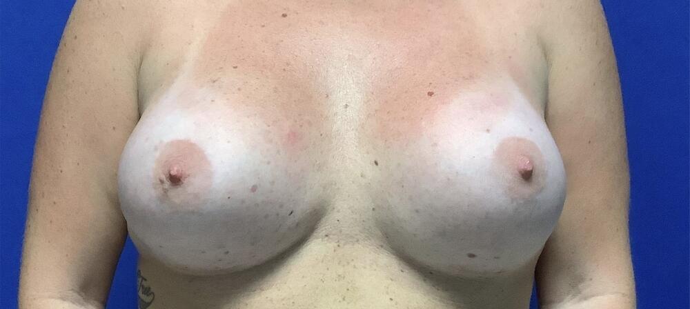 Breast Augmentation Melbourne Before & After | Patient 01 Photo 1