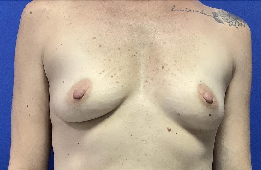 Breast Augmentation Melbourne Before & After | Patient 02 Photo 0 Thumb