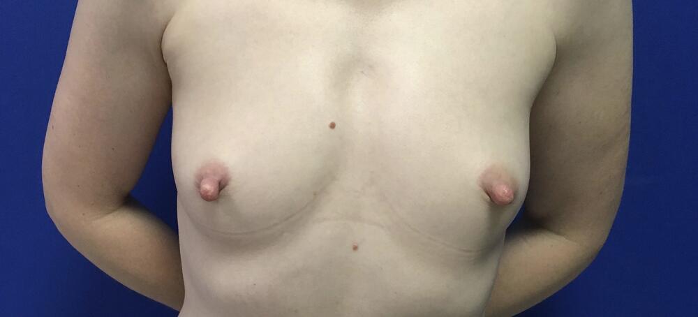 Breast Augmentation Melbourne Before & After | Patient 03 Photo 0