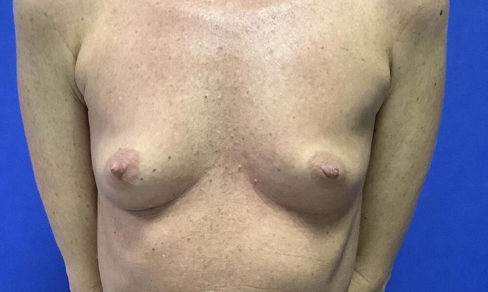 Breast Augmentation Melbourne Before & After | Patient 04 Photo 0 Thumb