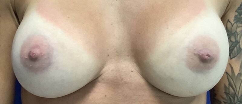 Breast Augmentation Melbourne Before & After | Patient 05 Photo 1 Thumb