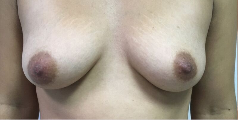 Breast Augmentation Melbourne Before & After | Patient 06 Photo 0
