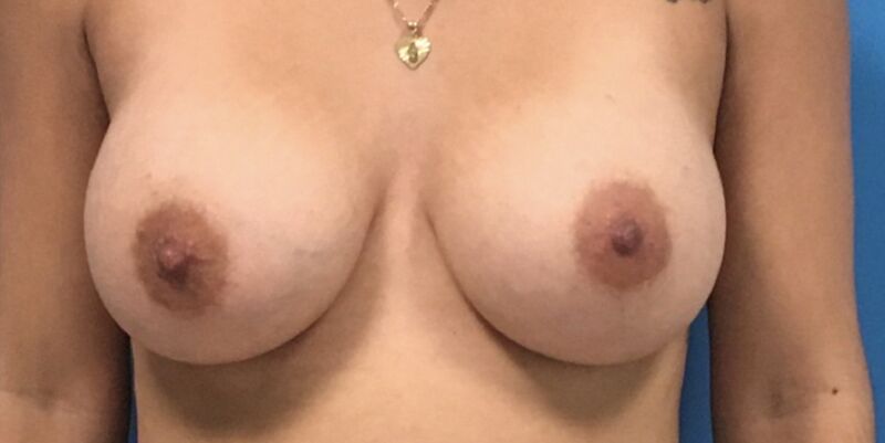 Breast Augmentation Melbourne Before & After | Patient 06 Photo 1