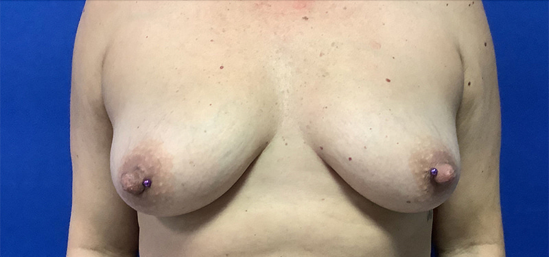 Breast Augmentation Melbourne Before & After | Patient 08 Photo 0 Thumb