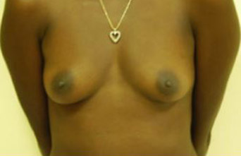 Breast Augmentation Melbourne Before & After | Patient 10 Photo 0