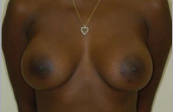 Breast Augmentation Melbourne Before & After | Patient 10 Photo 1