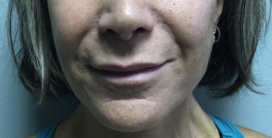 Lip Augmentation Melbourne Before & After | Patient 01 Photo 0