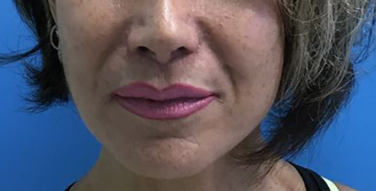 Lip Augmentation Melbourne Before & After | Patient 01 Photo 1 Thumb