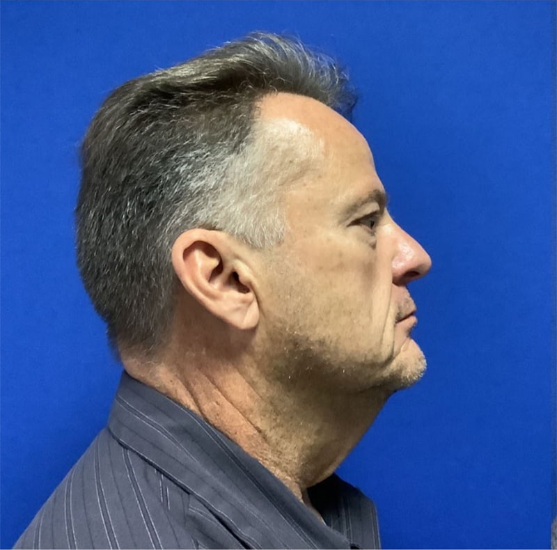 Neck Lift Melbourne Before & After | Patient 01 Photo 0 Thumb