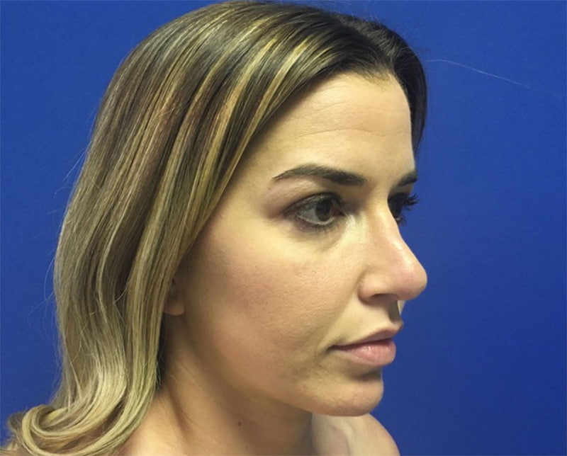 Rhinoplasty Melbourne Before & After | Patient 02 Photo 0 Thumb