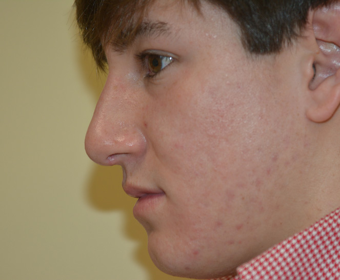 Rhinoplasty Melbourne Before & After | Patient 03 Photo 1