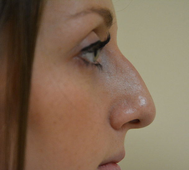 Rhinoplasty Melbourne Before & After | Patient 04 Photo 0