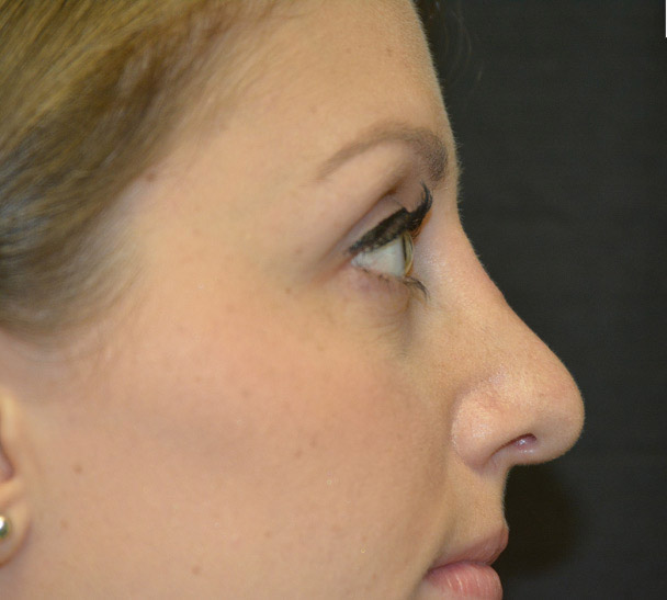 Rhinoplasty Melbourne Before & After | Patient 04 Photo 1