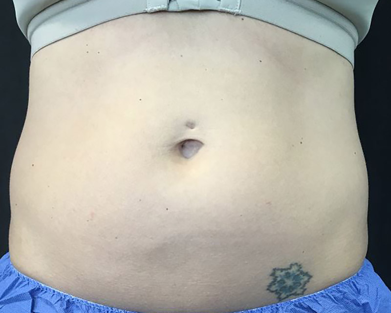 Coolsculpting Melbourne Before & After | Patient 01 Photo 0 Thumb