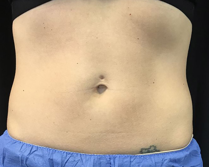 Coolsculpting Melbourne Before & After | Patient 01 Photo 1