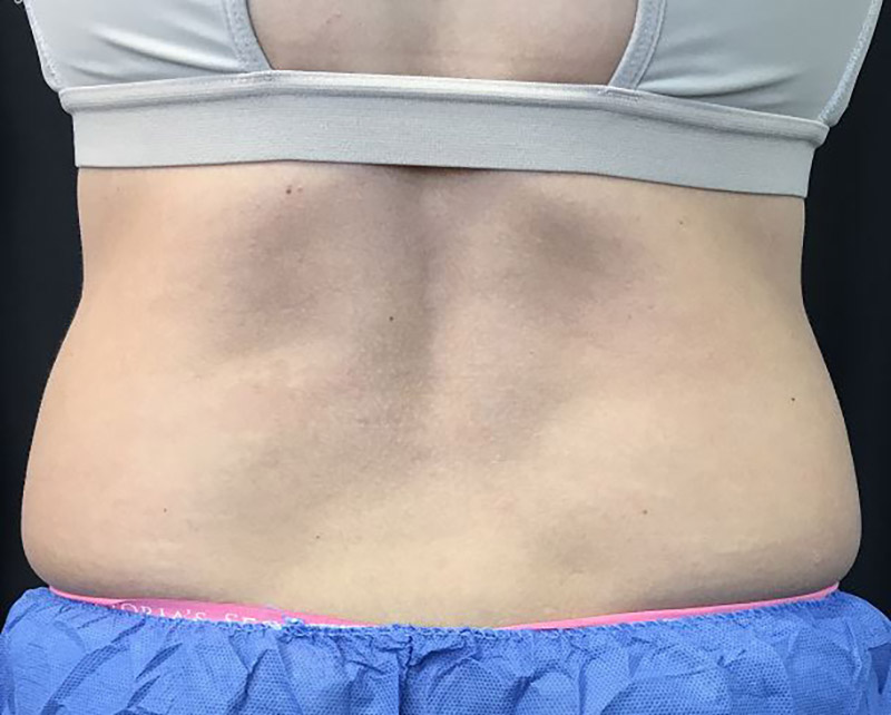 Coolsculpting Melbourne Before & After | Patient 01 Photo 4