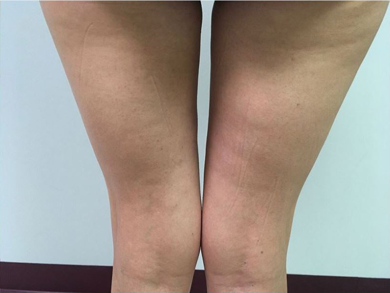 Coolsculpting Melbourne Before & After | Patient 02 Photo 1