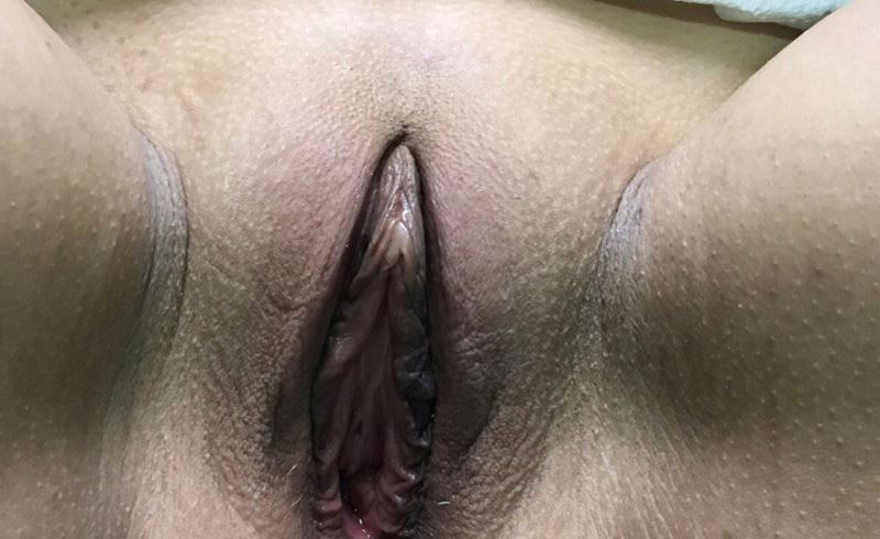 Votiva Vaginal Rejuvenation Melbourne Before & After | Patient 01 Photo 0 Thumb