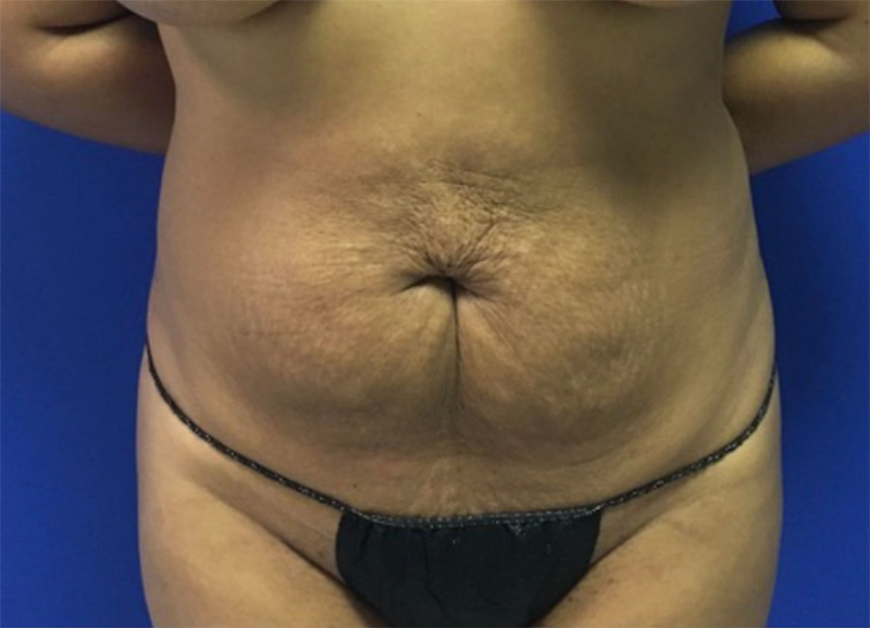 Before & After Tummy Tuck in Melbourne, FL