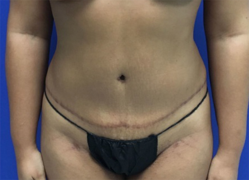 Tummy Tuck Melbourne Before & After | Patient 02 Photo 1