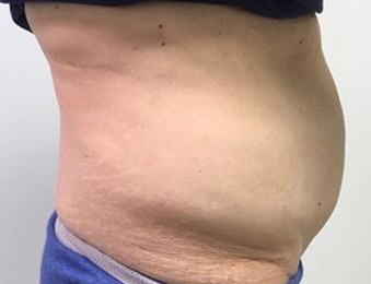 Tummy Tuck Melbourne Before & After | Patient 03 Photo 2