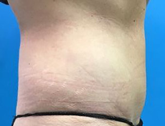 Tummy Tuck Melbourne Before & After | Patient 03 Photo 3