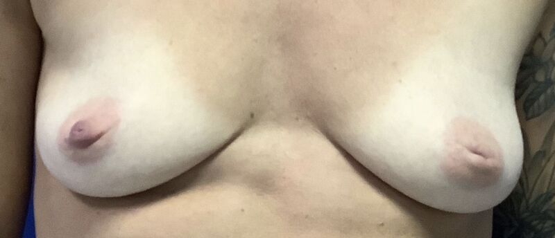 Breast Augmentation Melbourne Before & After | Patient 05 Photo 0