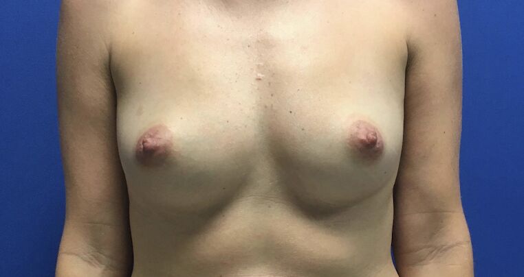 Breast Augmentation Melbourne Before & After | Patient 07 Photo 0