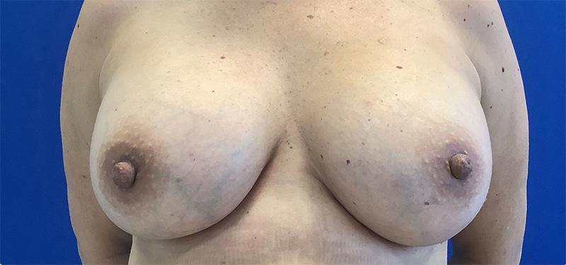 Breast Augmentation Melbourne Before & After | Patient 08 Photo 1