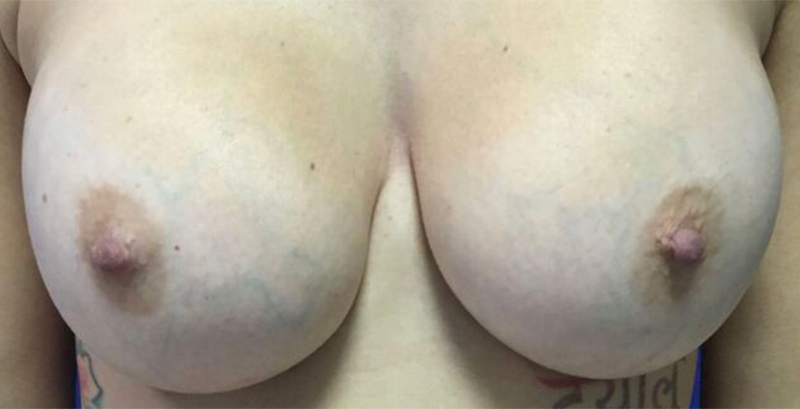 Breast Implant Exchange Melbourne Before & After | Patient 01 Photo 0