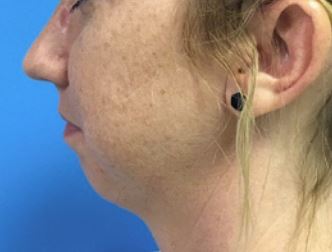 Chin Implant Melbourne Before & After | Patient 01 Photo 0