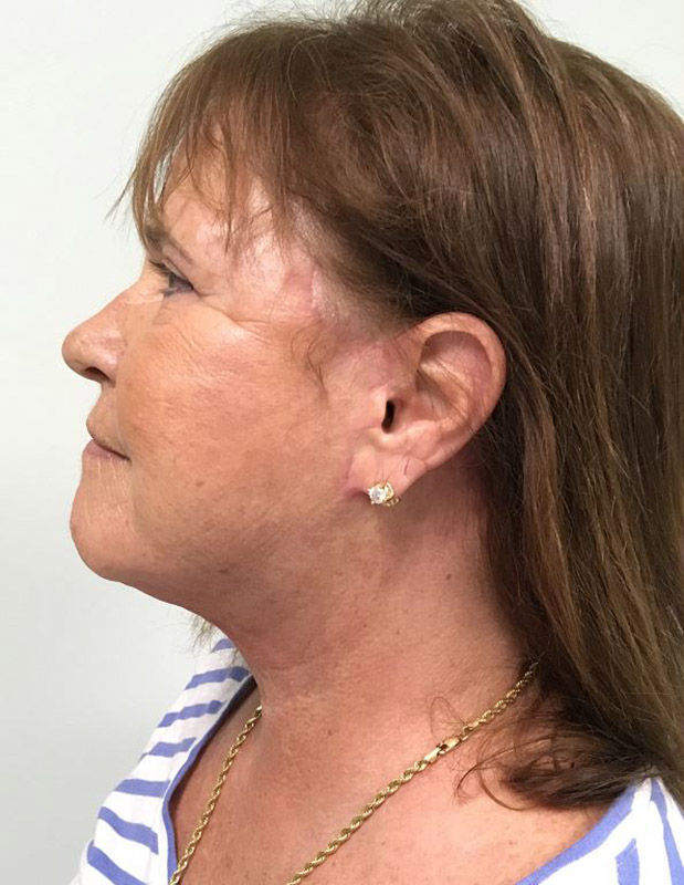 Facelift Melbourne Before & After | Patient 03 Photo 1