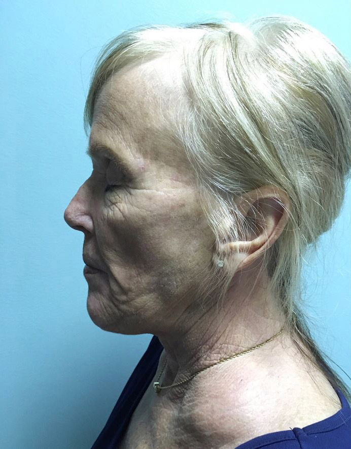 Facelift Melbourne Before & After | Patient 05 Photo 0